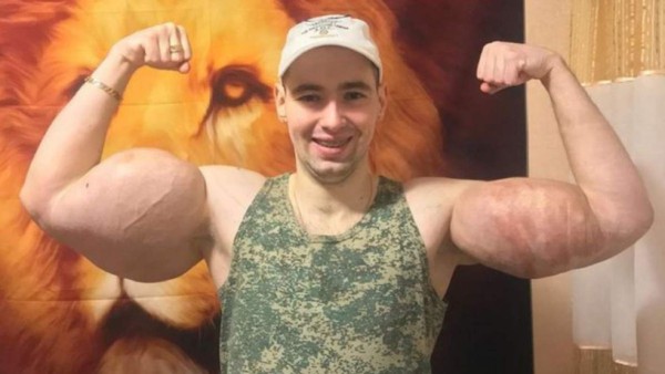 La fea lesión del Popeye ruso: le 'explotan' un brazo en plena pelea y anuncia que es el final