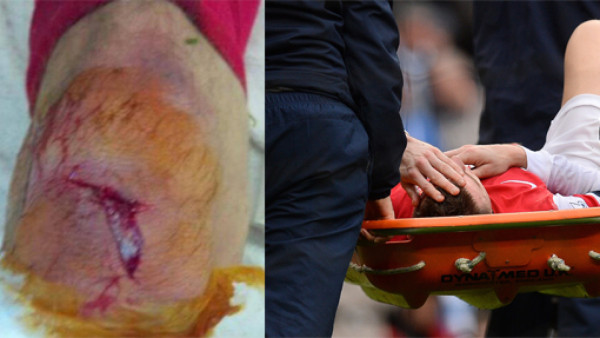 Koscielny sufre terrorífica lesión ante Manchester City