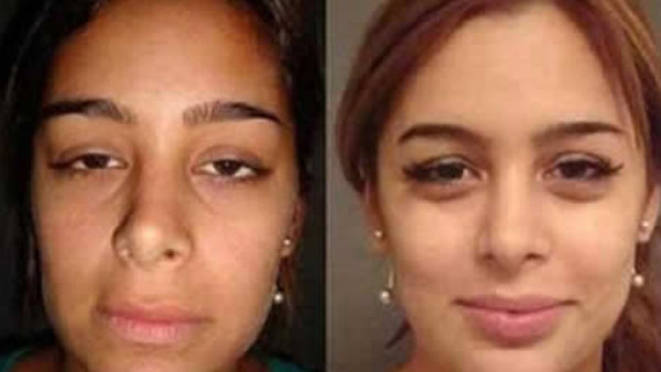 Larissa: antes y después del bisturí