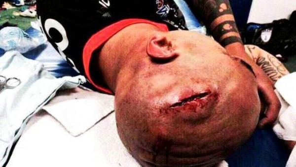 Escalofriantes: Las cicatrices más impactantes que han sufrido futbolistas y otros deportistas