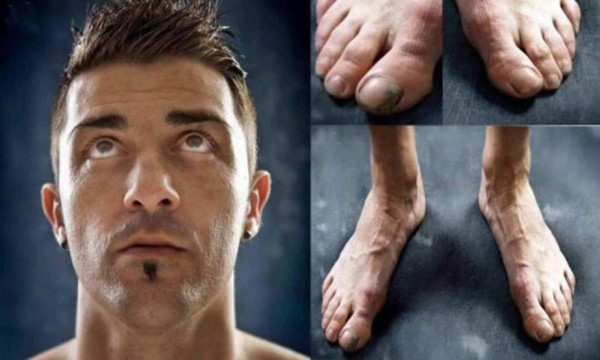 ¡HORRIBLES! Así son los pies más feos de los deportistas famosos