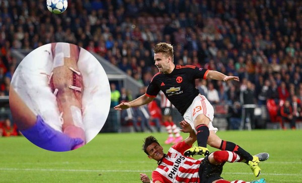 Jugadores con lesiones graves tienen mayor riesgo de tener problemas mentales