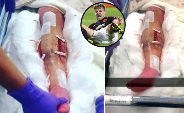 Escalofriante: ¡Así le quedó la pierna a Luke Shaw tras la operación!
