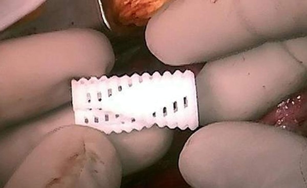 Impresora 3D cura a niños con enfermedades respiratorias