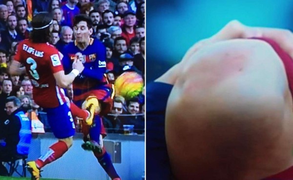 Así le dejó la rodilla el brasileño Filipe Luis a Leo Messi