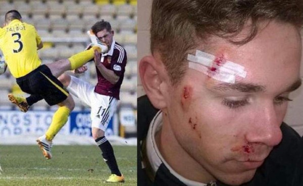 Así quedó el rostro de Sam Nicholson tras recibir tremenda patada de Talbot.