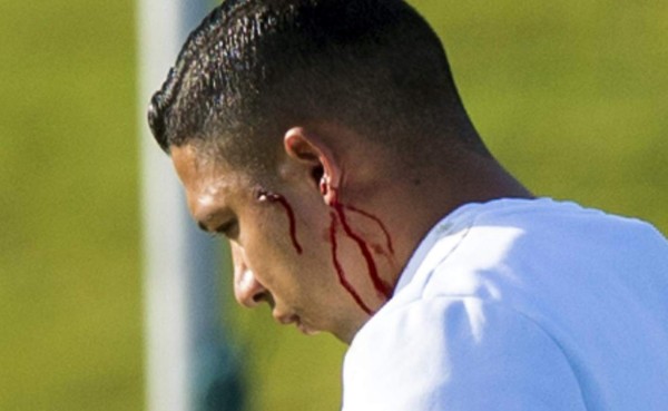 Emilio Izaguirre recibe puntos de sutura por golpe de compañero