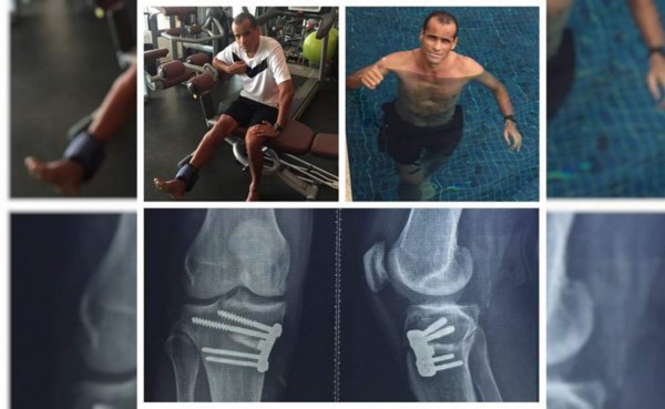 ¡Impactante! Así quedó la rodilla de Rivaldo tras la operación