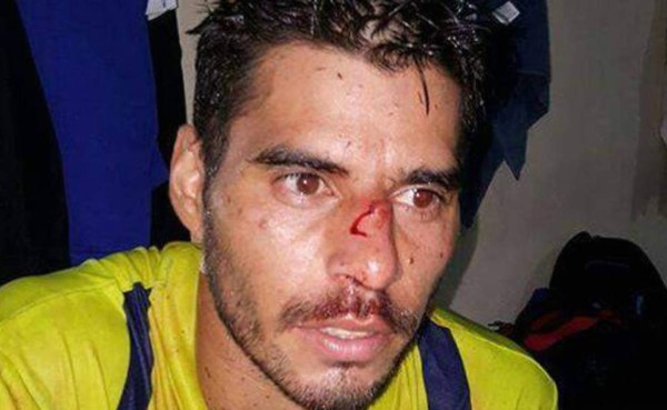 Paolo Suárez sufre codazo que le rompe la nariz en El Salvador