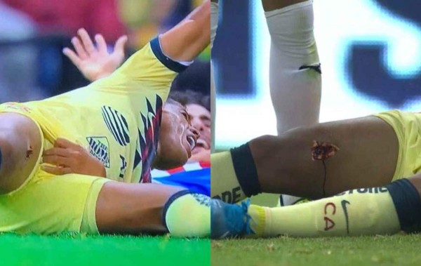 ¡De terror! Las lesiones más escalofriantes que se han visto en el mundo del fútbol