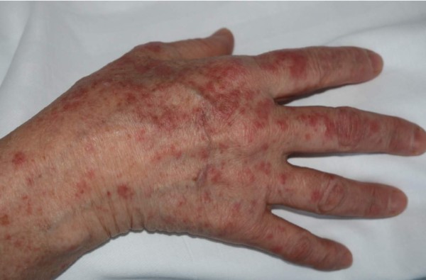 Nuevos síntomas del coronavirus: Las cinco manifestaciones que se producen en la piel&nbsp;&nbsp;