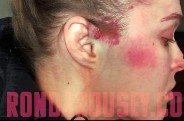 Moretones y heridas: Las fotos actualizadas de cómo quedó Ronda Rousey una semana depués de la paliza