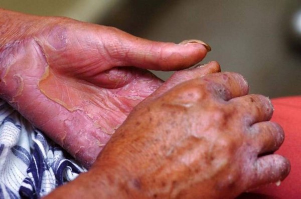 Alerta en México tras reportarse 89 casos de lepra, algo que pone en vigilancia al sector salud