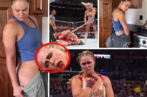 Moretones y heridas: Las fotos actualizadas de cómo quedó Ronda Rousey una semana depués de la paliza