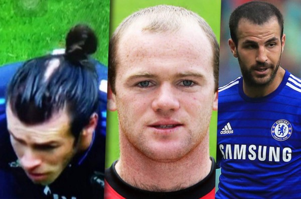 Famosos futbolistas que no soportaron su calvicie y decidieron hacerse injerto capilar