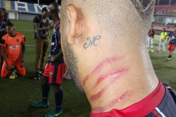 Pelea entre dos jugadores en Panamá deja a uno con serias heridas en el cuello
