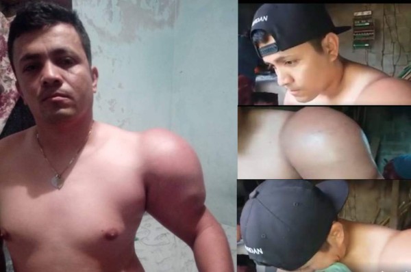 El drama de un futbolista amateur con un extraño cáncer en su hombro
