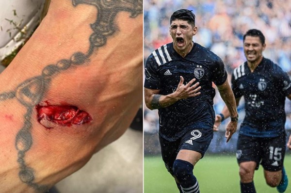 Mexicano Alan Pulido muestra la terrible herida que sufrió en la MLS: ''Ni siquiera marcaron falta''