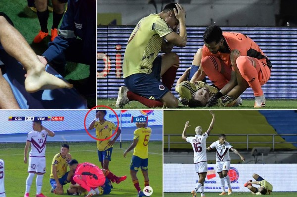 Dolorosas imágenes: así quedó el tobillo de Santiago Arias tras sufrir terrible lesión en el Colombia-Venezuela