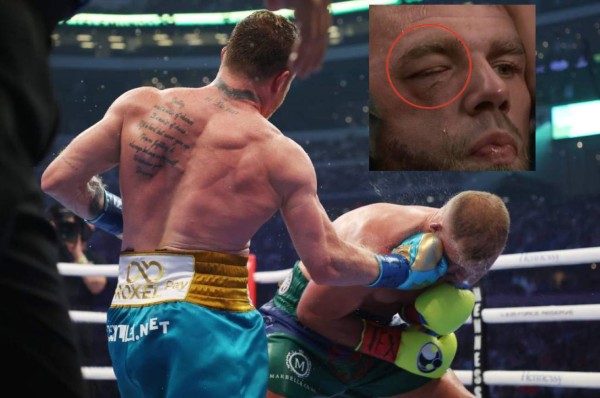 ¡Podría retirarse! 'Canelo' Álvarez le destrozó el pómulo a Saunders y se estima que colgaría los guantes