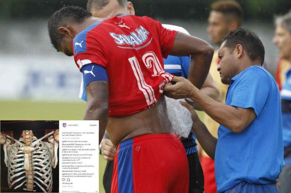 ¡Solo fracturas! Las graves lesiones que se han dado en la Liga Nacional