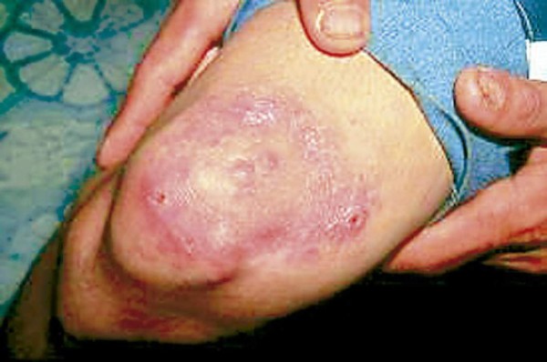 Alerta en México tras reportarse 89 casos de lepra, algo que pone en vigilancia al sector salud