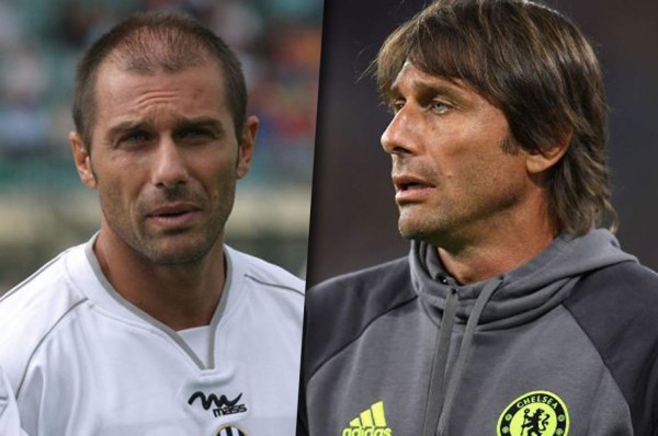 Famosos futbolistas que no soportaron su calvicie y decidieron hacerse injerto capilar