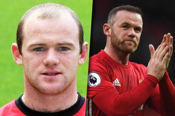 Famosos futbolistas que no soportaron su calvicie y decidieron hacerse injerto capilar