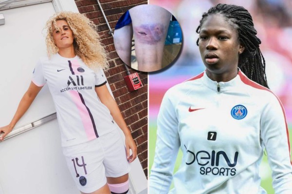 Jugadora del PSG muestra cómo le quedaron las piernas tras sufrir duro ataque: ''Traté de protegerme...''
