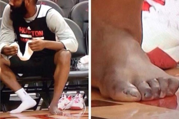 FOTOS: Así son los pies más feos de algunos deportistas reconocidos