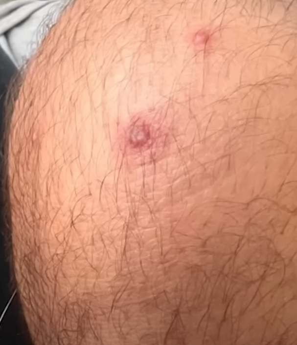 La pesadilla que vive un paciente con viruela del mono y muestra cómo tiene su cara: ‘‘Duele existir; este no soy yo’’