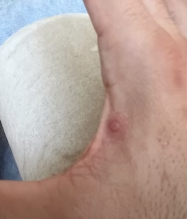 La pesadilla que vive un paciente con viruela del mono y muestra cómo tiene su cara: ‘‘Duele existir; este no soy yo’’