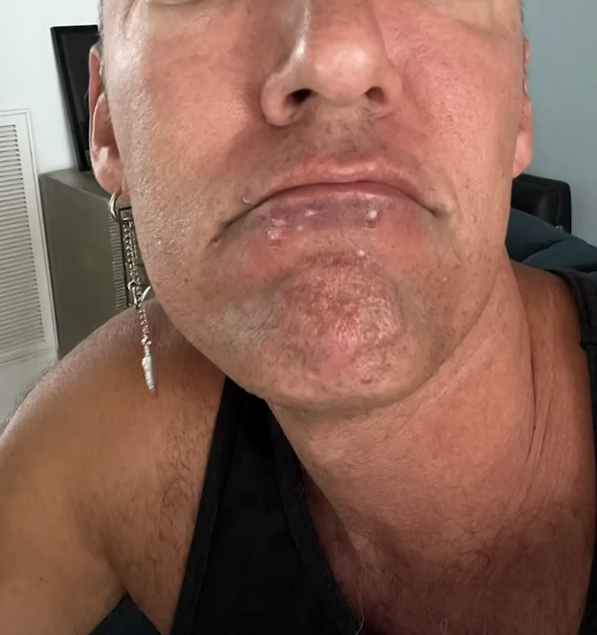 La pesadilla que vive un paciente con viruela del mono y muestra cómo tiene su cara: ‘‘Duele existir; este no soy yo’’