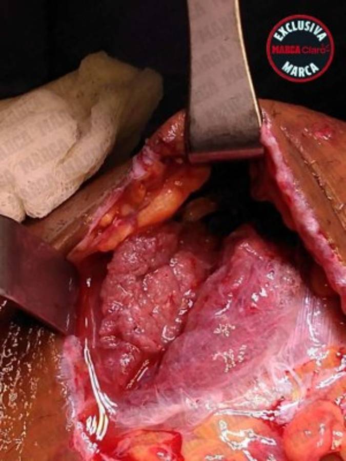 FOTOS: Reconstruyen el muslo de Gio Dos Santos tras lesión en el América-Chivas