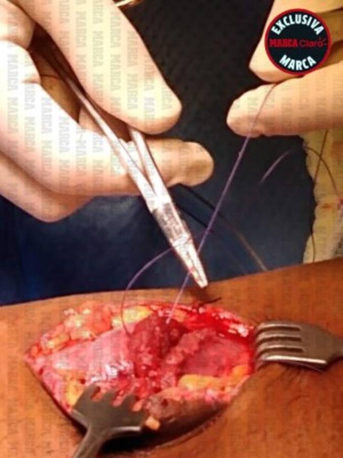 FOTOS: Reconstruyen el muslo de Gio Dos Santos tras lesión en el América-Chivas