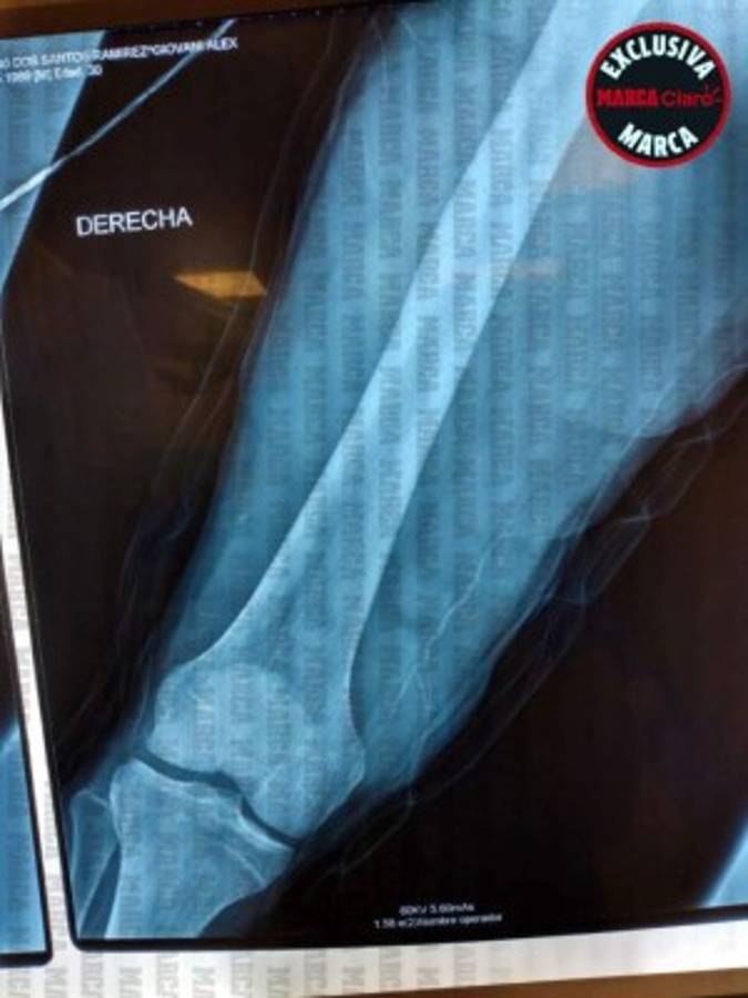 FOTOS: Reconstruyen el muslo de Gio Dos Santos tras lesión en el América-Chivas