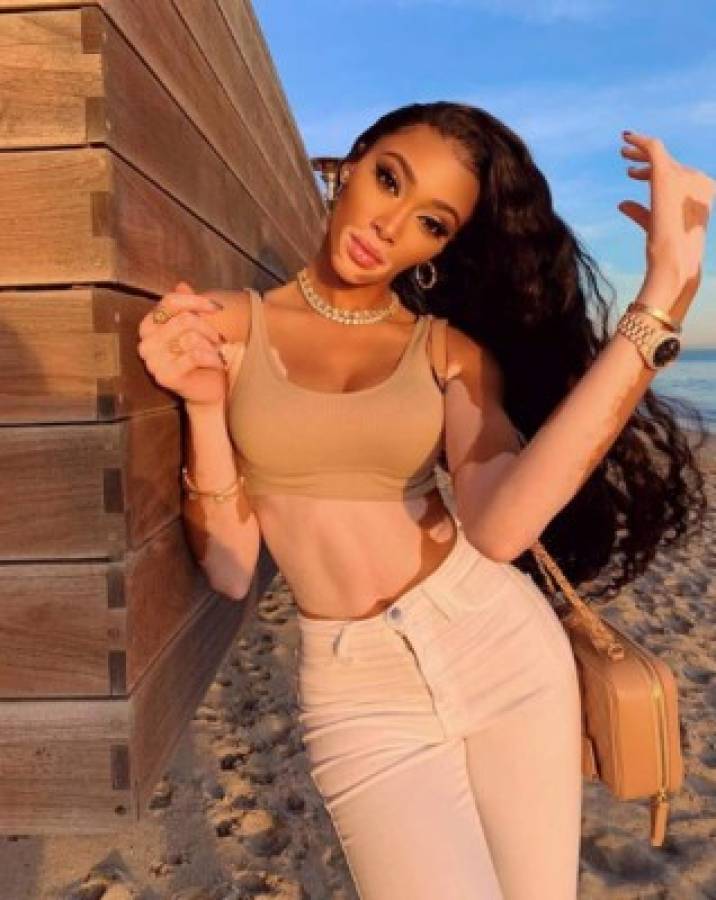 Winnie Harlow, preciosa modelo que padece de vitiligo, es 'cazada' con famoso deportista