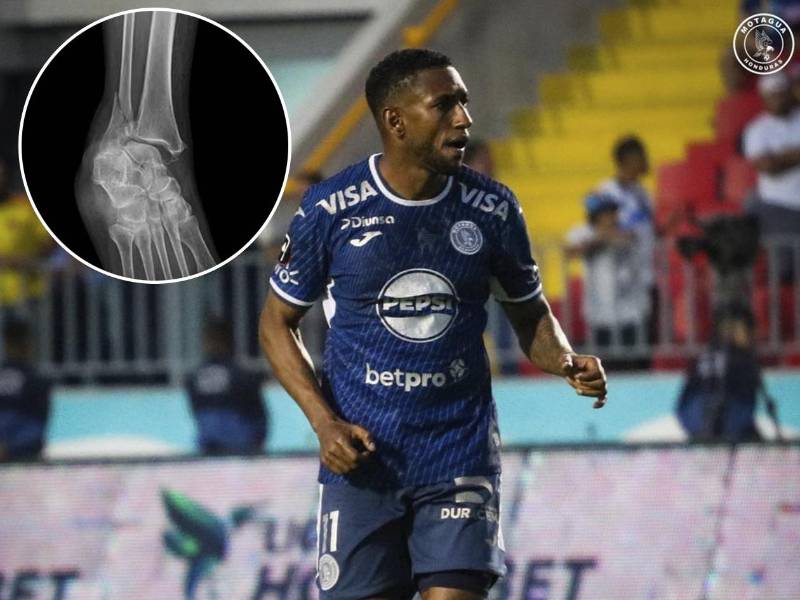 Romario Da Silva aún no ha sido operado ya que le tienen que limpiar el hueso.