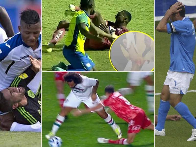 Romario da Silva, delantero de Motagua, se une a la lista de jugadores que sufrieron una terrible lesión en su carrera.