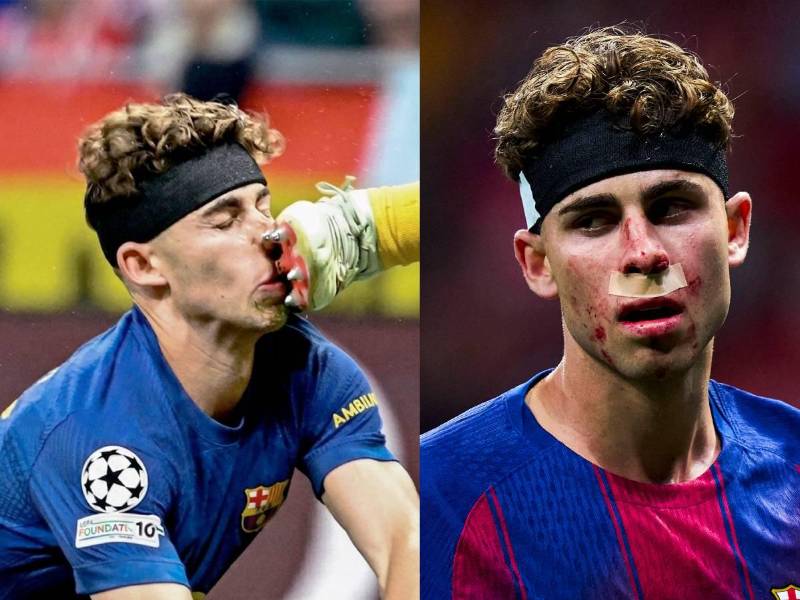 Fermín y la herida que le dejó el encuentro entre el Barcelona y Atlético de Madrid. Fotos cortesía.