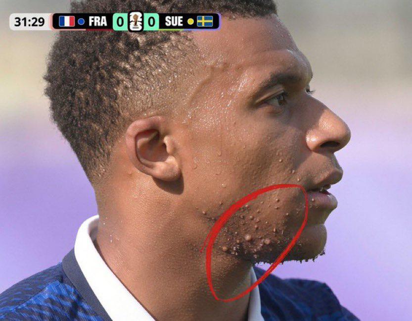 Mbappé y las marcas en su cara: ¿Qué está pasando con el crack de Francia y Real Madrid?