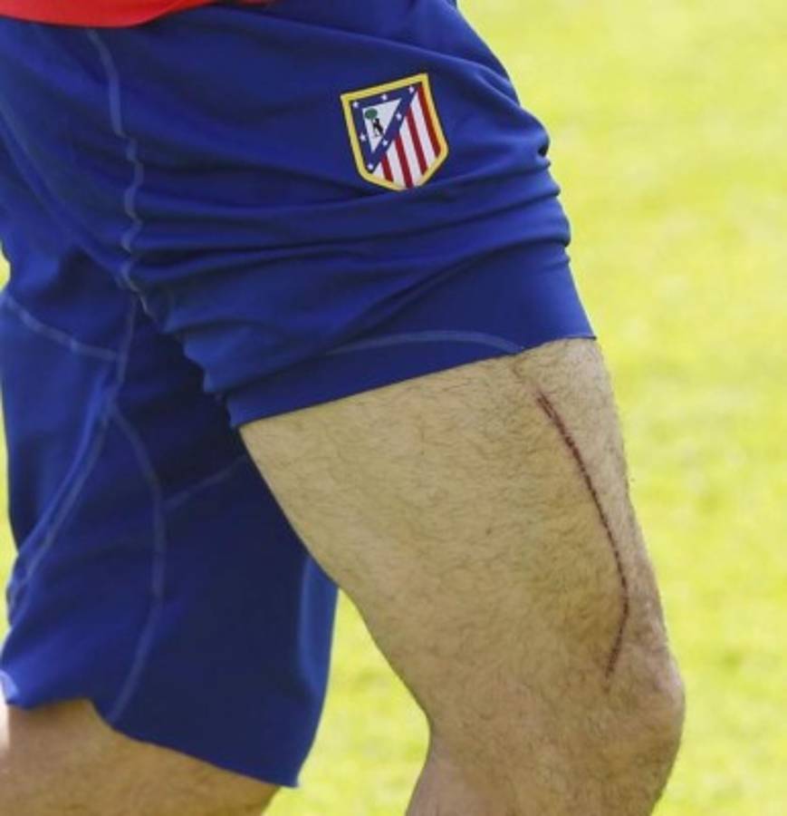 Escalofriantes: Las cicatrices más impactantes que han sufrido futbolistas y otros deportistas