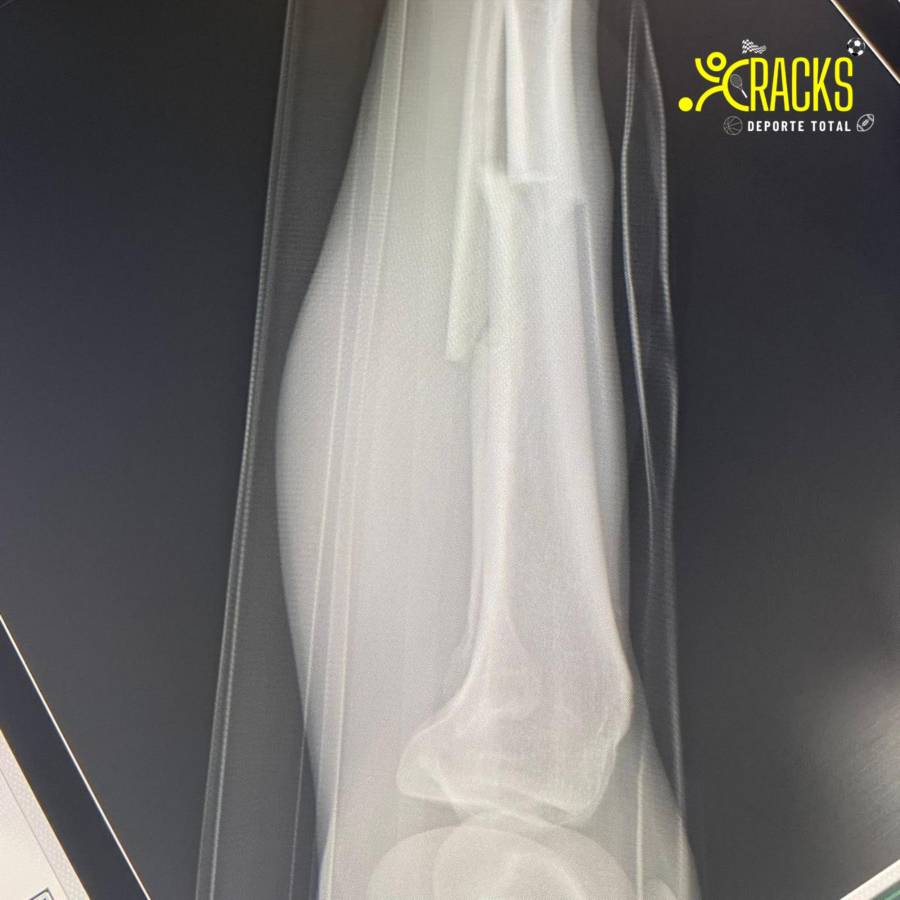 Escalofriante lesión del mexicano Hobbit Bermúdez: así quedó la pierna del jugador y la bronca con el culpable