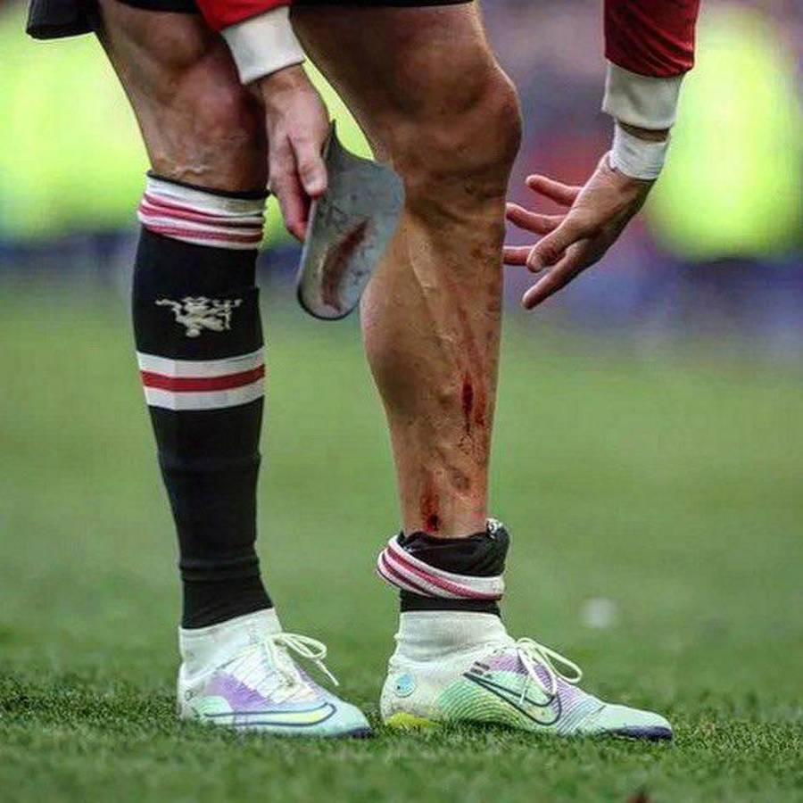 Escalofriante: así le quedó la pierna a Cristiano Ronaldo en la dolorosa derrota del Manchester United