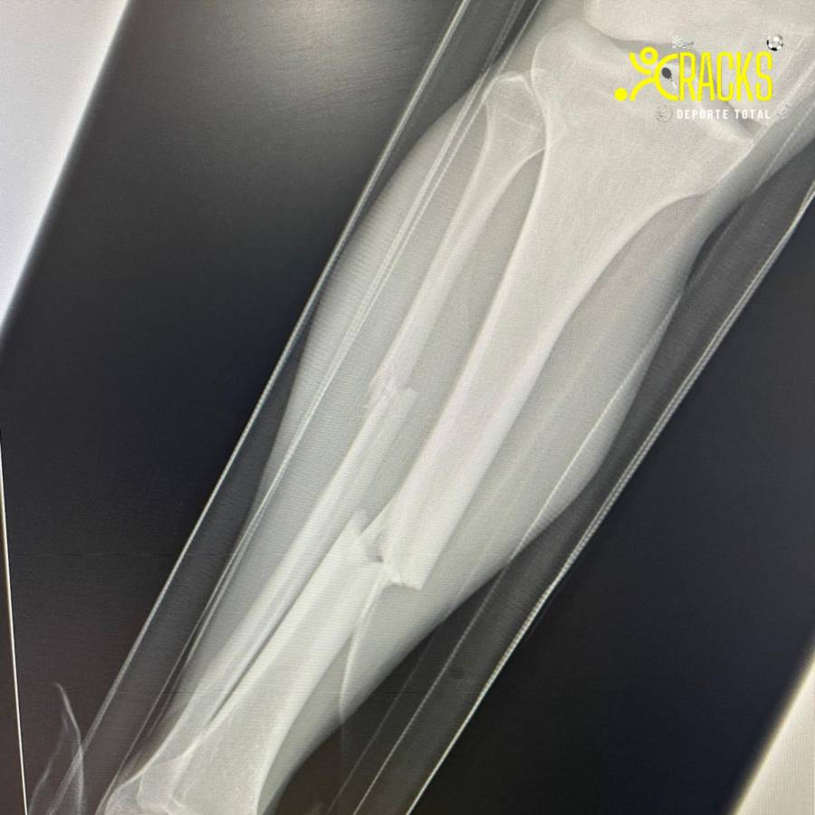 Escalofriante lesión del mexicano Hobbit Bermúdez: así quedó la pierna del jugador y la bronca con el culpable