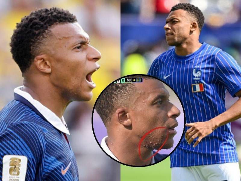 Kylian Mbappé tiene una marcas en la cara y todos se preguntan a qué se debe y esto es lo que informan desde la dermatología.