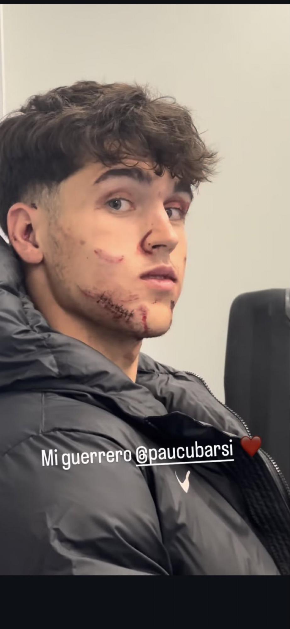 Terrible herida de Cubarsí que terminó con 10 puntos en la cara, crisis en el PSG y el penal más tonto en la historia de la Champions