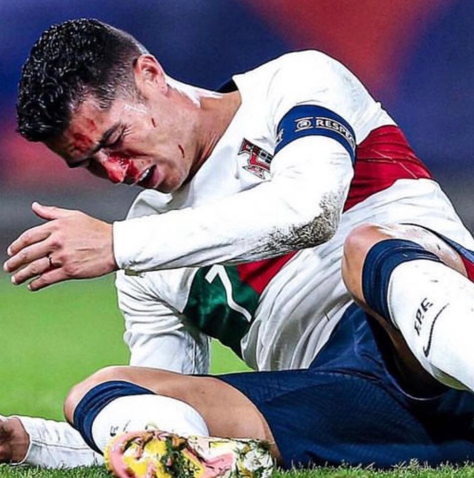 Los checos le dieron con todo: Cristiano Ronaldo sufre durísimo golpe que lo dejó tendido en el suelo y sangrando