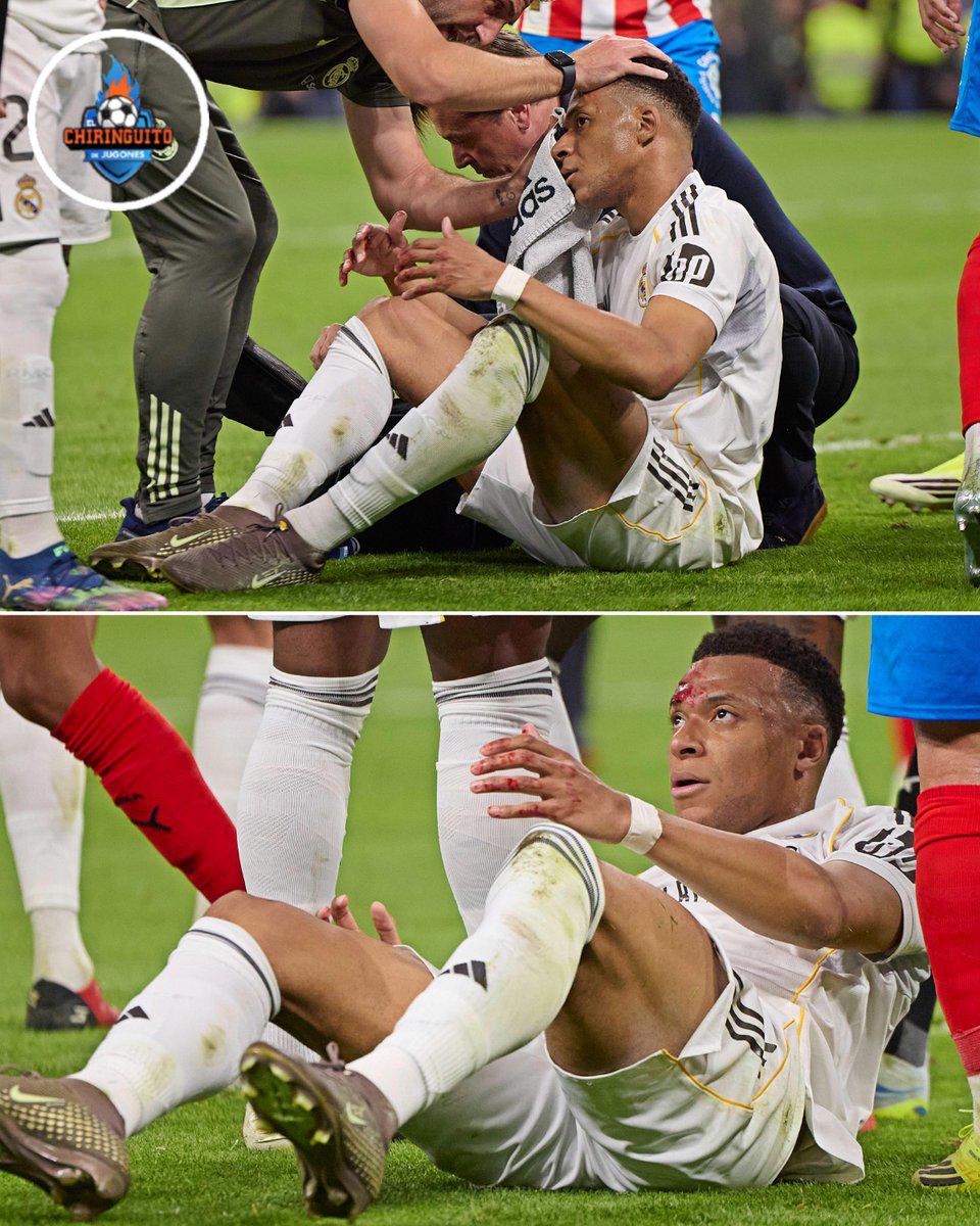 Mbappé y las marcas en su cara: ¿Qué está pasando con el crack de Francia y Real Madrid?